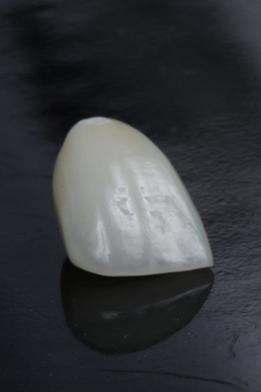 Zirconia Single Crown